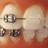 braces