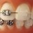 braces